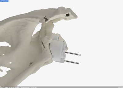 Reconstrucción glenoidea para protesis invertida