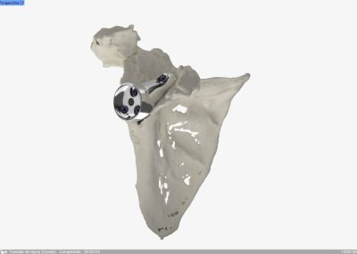 Reconstrucción glenoidea para protesis invertida