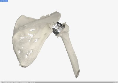 Reconstrucción glenoidea para protesis invertida