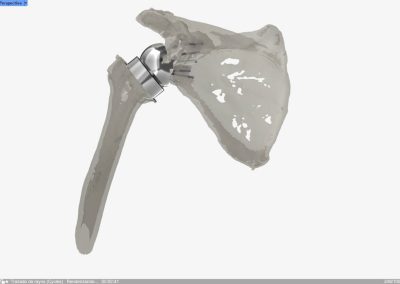 Reconstrucción glenoidea para protesis invertida