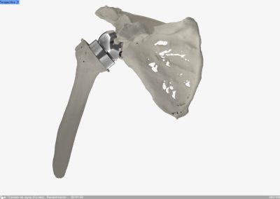 Reconstrucción glenoidea para protesis invertida