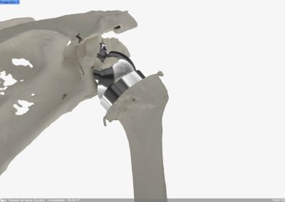 Reconstrucción glenoidea para protesis invertida