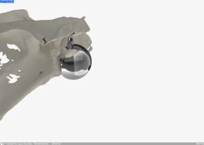 Reconstrucción glenoidea para protesis invertida