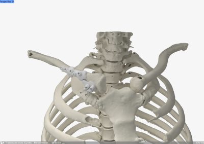 Osteotomía Clavícula