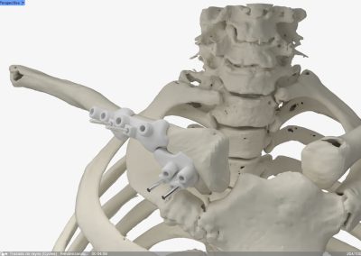 Osteotomía Clavícula