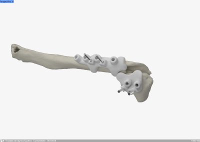 Osteotomía Clavícula