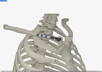 Osteotomía Clavícula