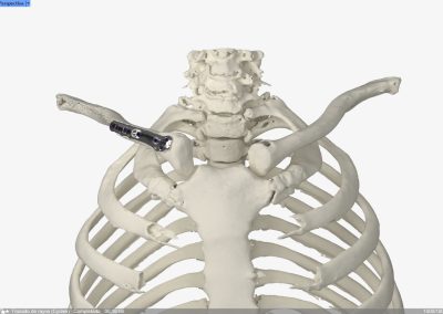 Osteotomía Clavícula